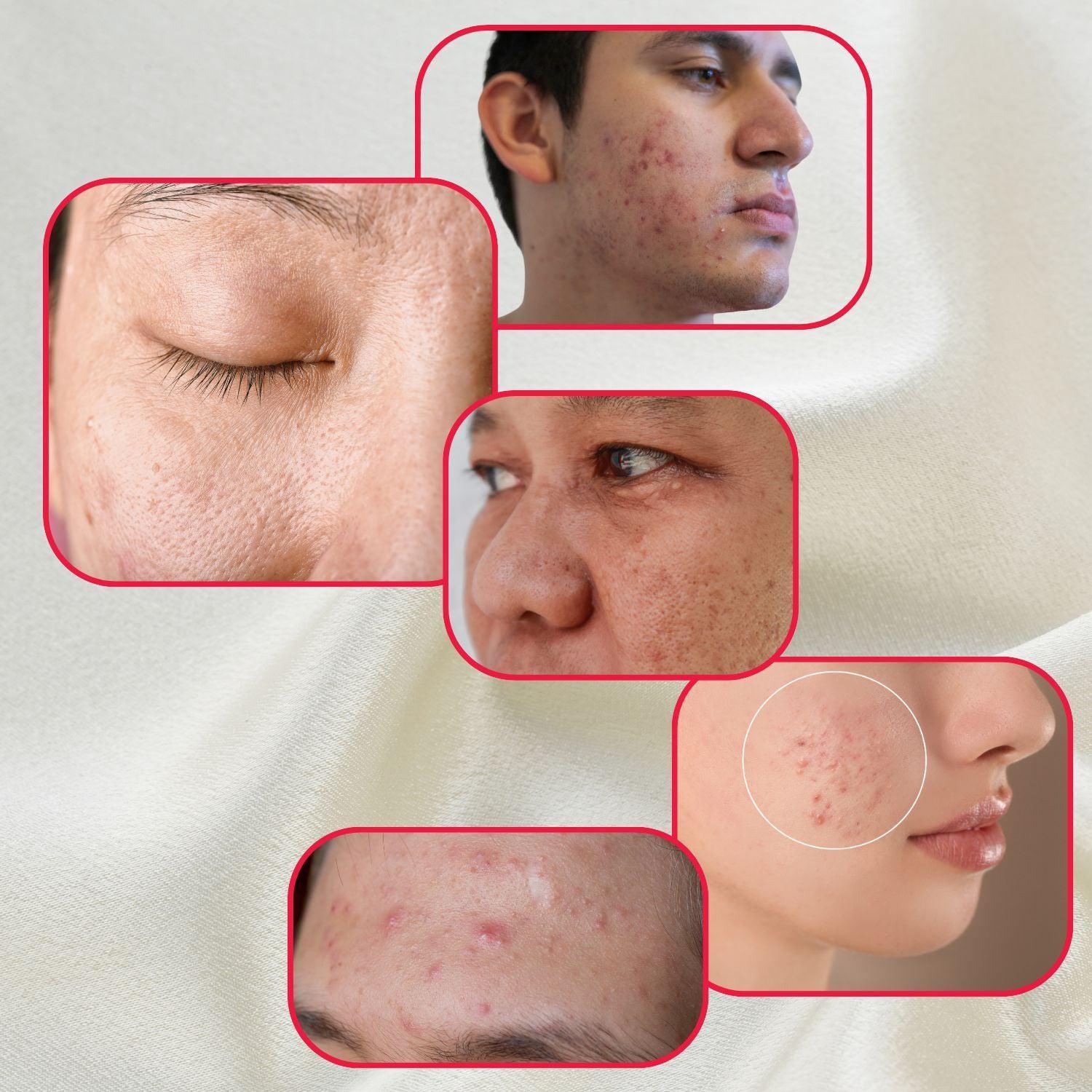 Perfect Trifecta AHA Resurfacing Peel