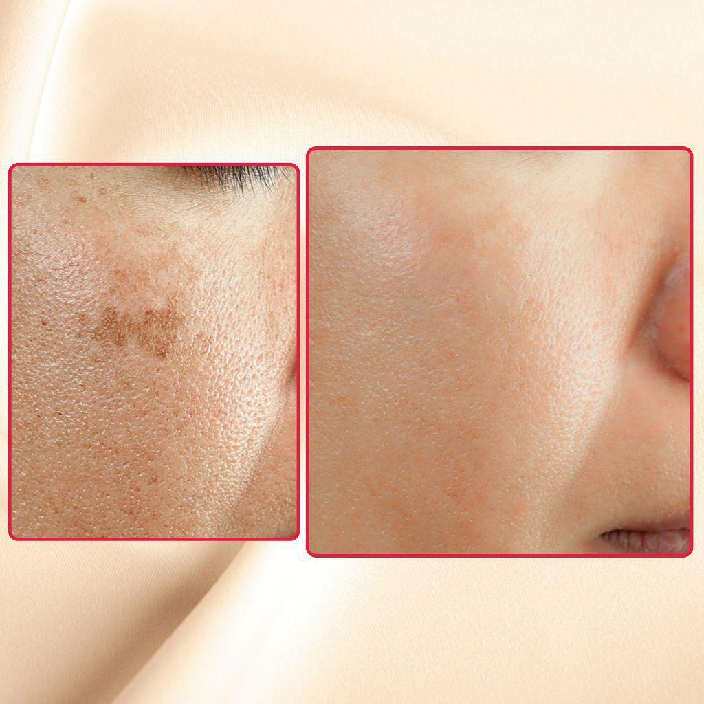 The Eraser Spot Cream | Dark Spot Correcting Moisturizer